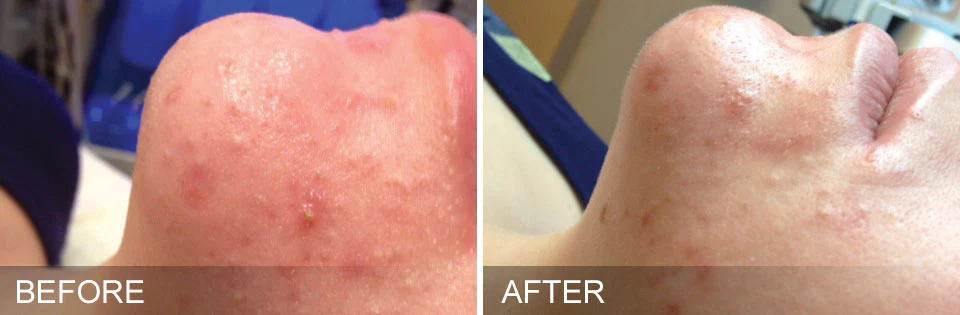 Hydrafacial® Deluxe - Image 3