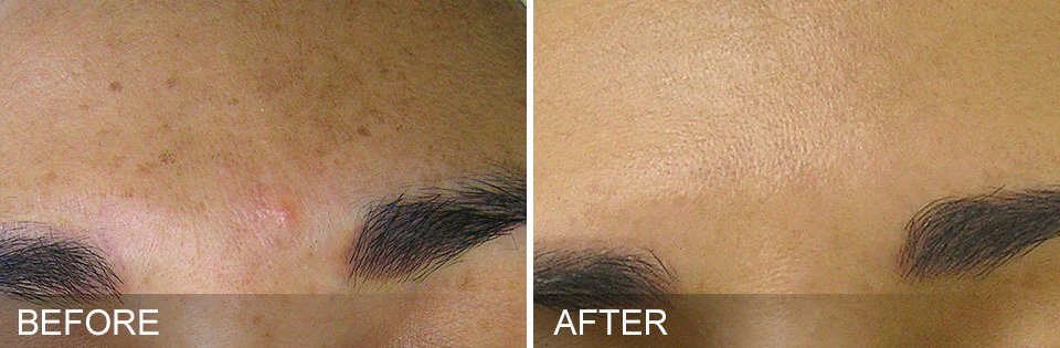 Hydrafacial® Deluxe - Image 5